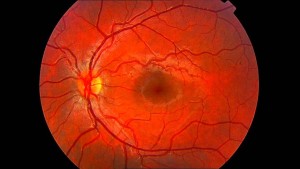 retinografía 3